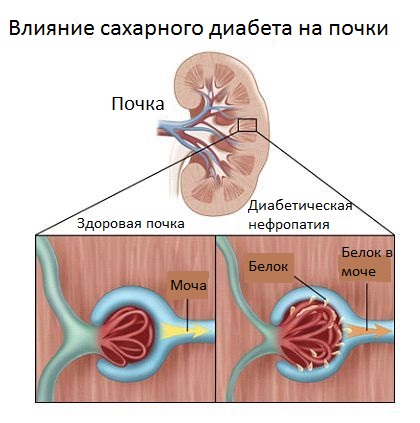 Последствия сахарного диабета