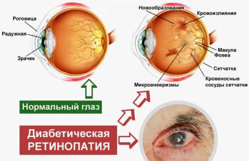 Последствия сахарного диабета