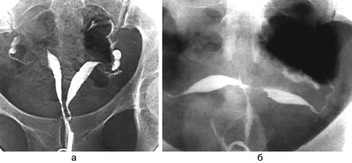 Пороки развития. Внутриматочная перегородка (а) и двурогая матка (б).