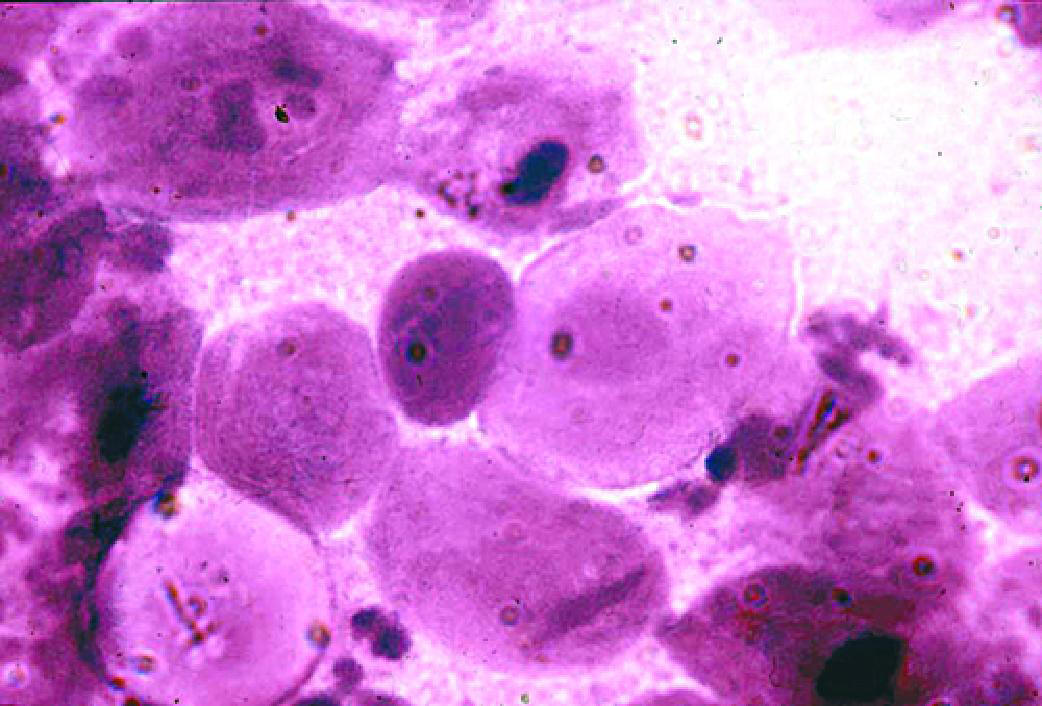 Вагинальная эпителиальная атрофия (микроскопия мазка, окрашенного по Граму).