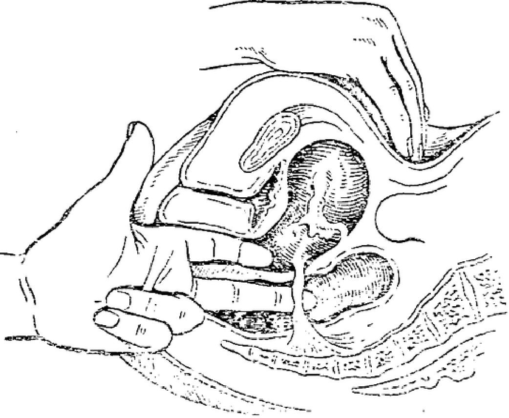 Бимануальное влагалищное исследование 18