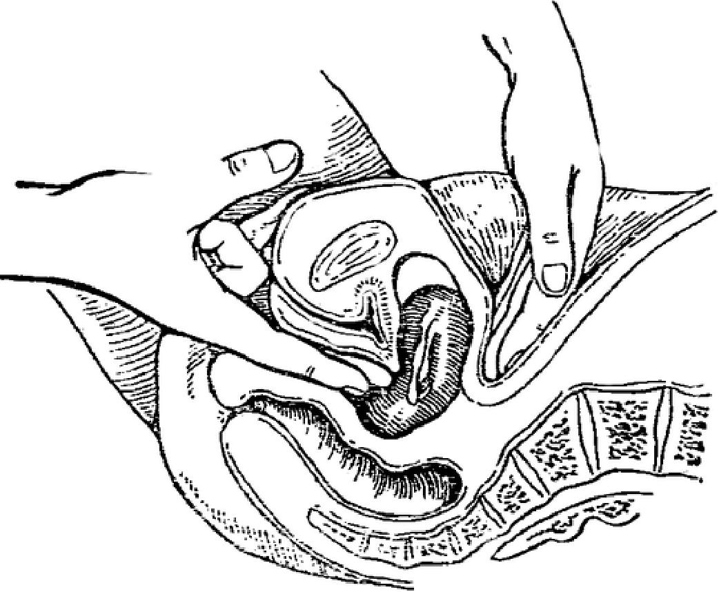 Бимануальное влагалищное исследование 16