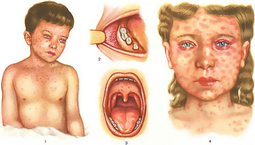 Корь. Причины, симптомы и лечение кори.