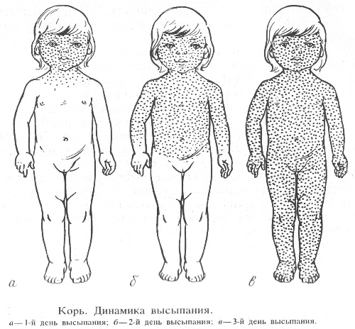Корь. Причины, симптомы и лечение кори.