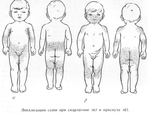 Краснуха. Причины, симптомы и лечение краснухи