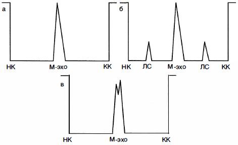 Рис. 1 0-3. Варианты эхограмм в норме