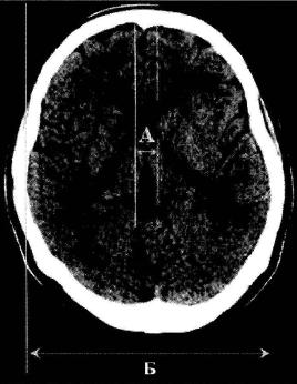 Рис. 10-4. Практическая аналогия ширины 111 желудочка при ЭхоЭС и кт. Д - ширина III желудочка; Б - расстояние между внутренними пластинками костей черепа.