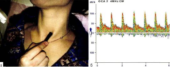 Рис. 11-2. Датчик в проекции локации общей сонной артерии (а) . Спектр потока по неизменённой общей сонной артерии ( б ) .