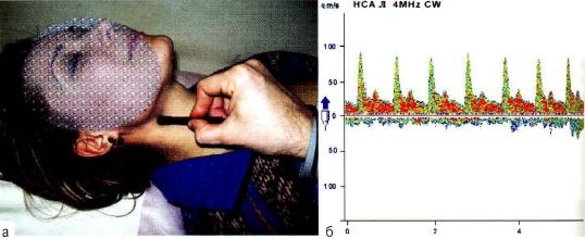 Рис . 11-4. Датчик в проекции локации наружной сонной артерии 