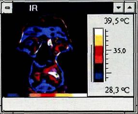 Рис. 12- 2 . Кластерная головная боль, Термограмма лица: выраженная гипертермия с температурным градиентом 4 0С во внутреннем углу левой глазницы в момент болевого приступа