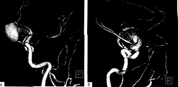 Рис. 19-11 . Гигантская аневризма супраклиноидного отдела правой внутренней сонной артерии