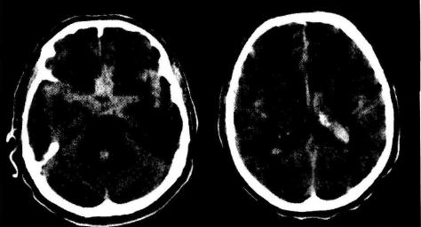 Рис. 19-13. Массивное субарахноидально-вентрикулярно-паренхиматозное кровоизлияние (компьютерная томограмма)