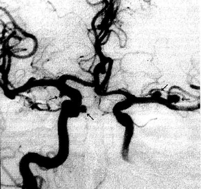 Рис. 19-19. Множественные аневризмы сосудов мозга 