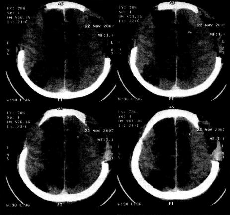 Рис. 19-21 . Множественные очаги ишемии в бассейнах обеих передних и средних мозговых артерий вследствие выраженного диффузного ангиоспазма