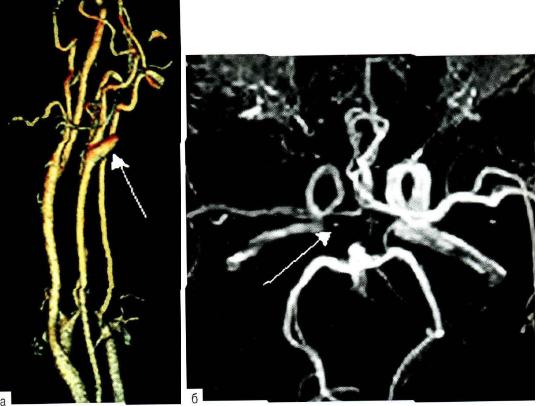  Рис. 19-3. Магнитно-резонансная ангиография: а - тромбоз внутренней сонной артерии; б - артерии виллизиева круга, аплазия правой задней соединительной артерии