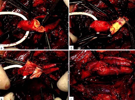 Рис. 19-7. 3версионная каротидная эндартерэктомия