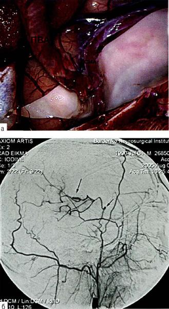 Рис. 19-9. 3кстра-интракраниальный анастомоз