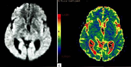 Рис. 3-10. Диффузионная МРТ. а - диффузионно-взвешенное изображение (комбинированное), полученное с фактором диффузии b = 1000 с/мм2; б - диффузионная цветовая карта на этом уровне.