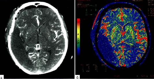 Рис. 3-15 . Острая ишемия в бассейне средней мозговой артерии слева