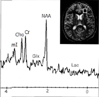 Одновоксельная протонная МР-спектроскопия вещества мозга в норме. Пики основных метаболитов обозначены на рисунке