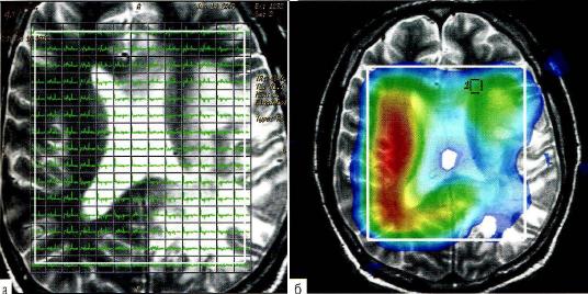 Рис. 3-19 . Мулыивоксельная протонная МР-спектроскопия вещества мозга у больного с лимфангитом ЦНС
