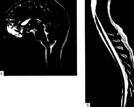 Рис. 3-5. Магнитно-резонансная цистернография (а) и миелография (б).