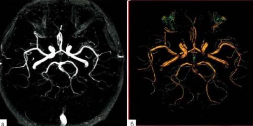 Рис. 3 - 6. Времяпролётная Т1 -МР-ангиография с подавлением сигнала от стационарных (мозговых) тканей