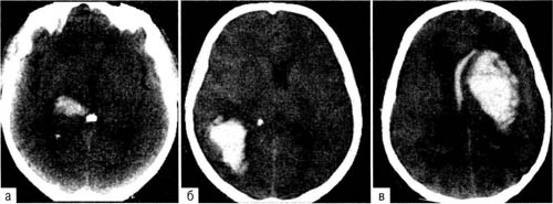 Внутримозговые гематомы разных локализации и объёма ( КТ)