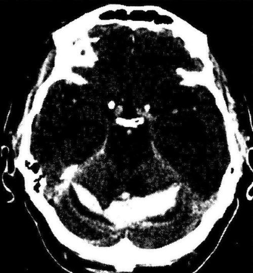 Внутримозговая гематома червя и обоих полушарий мозжечка (КТ)