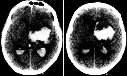 Большая смешанная гематома глубинных отделов левого полушария с прорывом в III желудочек, частичным заполнением кровью боковых желудочков, выраженная дислокация мозга вправо (КТ).  
