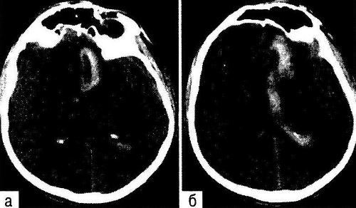 ипичная локализация внутримозговой гематомы при разрыве аневризмы передней мозговой/ передней соединительной артерии (КТ). 