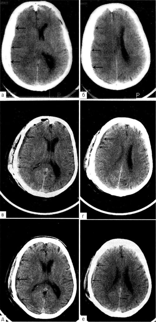 Острая субдуральная гематома правой лоб но-темен но-височной области