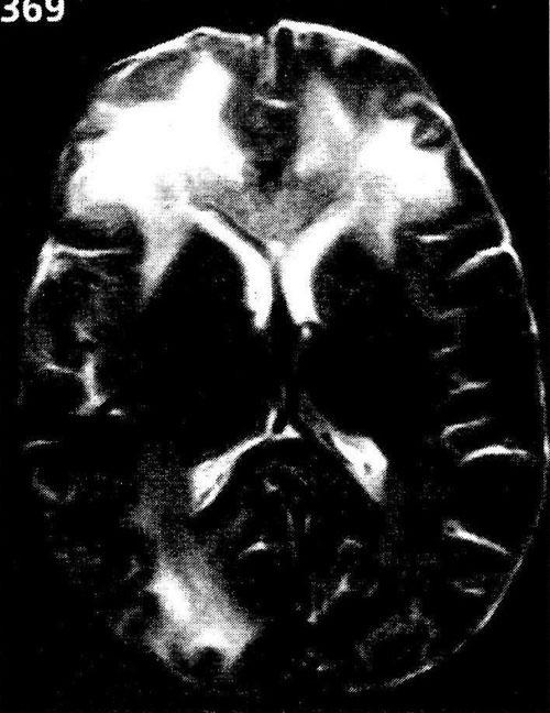 МРТ головного мозга при подостром склерозирующем энцефалите