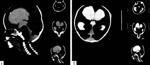  КТ-вентрикулография у ре6ёнка с открытой гидроцефалией сагиттальная (а) и фронтальная (6) проекция