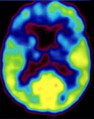 Рис. 5-3. ПЭТ при деменции лобного типа. Билатеральные зоны гипометаболизма в лобных и височных долях головного мозга