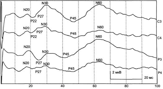 Рис. 7- 1 . ССВП здорового человека при стимуляции правого срединного нерва.