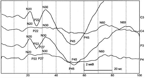 Рис. 7-2. ССВП больного с постинсультной эпилепсией