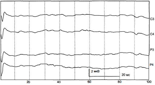 Рис. 7-3. ССВП больной с тяжёлым ишемическим инсультом