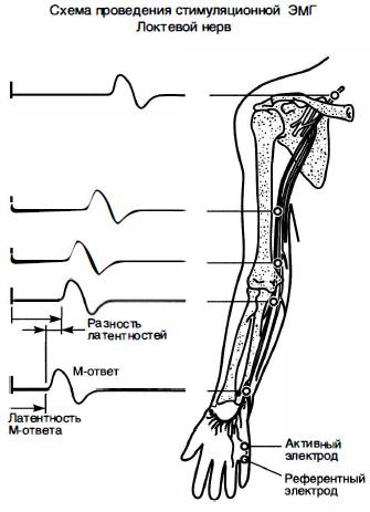 Рис. 8-2. Схема исследования проводящей функции локтевого нерва